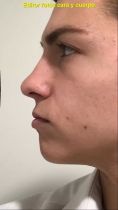Cirugía de la nariz (Rinoplastia) - Foto Antes de - Dr. Diego Cunille
