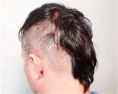 Haartransplantation - Vorher Foto - Prohaarklinik