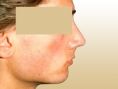 Rhinoplasty (Nose Job) - Photo before - Dr. med. Gunther Arco