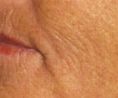 Fotorejuvenation - Photo before - Klinika Laser Esthetic