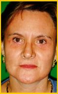 Fotorejuvenecimiento (IPL) - rejuvenecimiento de la piel - Foto Antes de - Dr. Aristides Arellano-Huacuja