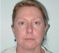 Facelift - Photo before - Dr. Michael Zacharia