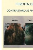 Trapianto capelli - Foto del prima - Dott. Salvatore Scandura M.D.