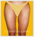 Liposukcja (odsysanie tłuszczu) - Zdjęcie przed - MUDr. Taisir Zakout