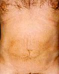 Liposuction - Photo before - Klinika Laser Esthetic