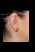 Ear surgery (Otoplasty) - Photo before - Dr. Rodrigo Morales De la Cerda