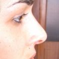 Cirugía de la nariz (Rinoplastia) - Foto Antes de - Dr. Alfonso Quetglas Marimón