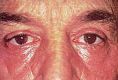 Eyelid surgery (Blepharoplasty) - Photo before - Klinika Laser Esthetic