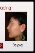 Rejuvenecimiento facial con láser fraccionado - Foto Antes de - Dr. Aristides Arellano-Huacuja