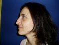 Rhinoplasty (Nose Job) - Photo before - Klinika Laser Esthetic