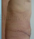 Abdominoplasty (Tummy Tucks) - Photo before - Dr. med. Jozefina Skulavik