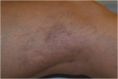 Eliminare capillari e teleangectasie con laser - Foto del prima - Dr. Luigi Mazzi