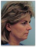 Facelift - Photo before - Wafik A Hanna