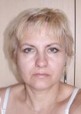 Eyelid surgery (Blepharoplasty) - Photo before - Klinika Laser Esthetic