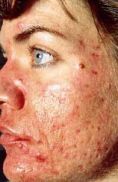 Laser acne treatment - Photo before - Klinika Laser Esthetic