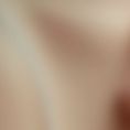 Breast Augmentation - Breast Implants - Photo before - Adam J. Rubinstein M.D., FACS