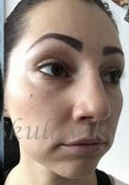 Septoplasty - Photo before - Dr. med. Jozefina Skulavik