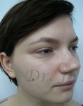 Septoplasty - Photo before - Dr. med. Jozefina Skulavik