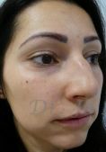 Septoplasty - Photo before - Dr. med. Jozefina Skulavik