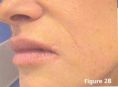 Mesotherapy (face, neck revitalization) - Photo before - Klinika Laser Esthetic