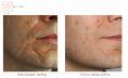 Laser Scar Treatment - Photo before - Dr n. med. Marcin Bieńkowski
