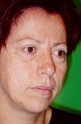 Fotorejuvenecimiento (IPL) - rejuvenecimiento de la piel - Foto Antes de - Dr. Aristides Arellano-Huacuja