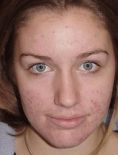 Laserová léčba akné - fotka před - Esthé Laser Clinic