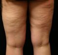 - Photo before - Klinika Laser Esthetic