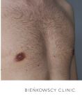 Gynecomastia (Male Breast Reduction) - Photo before - Bieńkowscy Clinic®