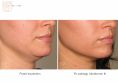 Ultherapy - Photo before - Dr n. med. Marcin Bieńkowski