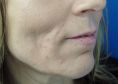 Lipofilling, Lipografting, Lipotransfer (přenos a aplikace vlastního tuku) - fotka před - MUDr. Evžen Trupar Ph.D.