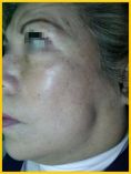 Fotorejuvenecimiento (IPL) - rejuvenecimiento de la piel - Foto Antes de - Dr. Aristides Arellano-Huacuja