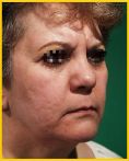 Fotorejuvenecimiento (IPL) - rejuvenecimiento de la piel - Foto Antes de - Dr. Aristides Arellano-Huacuja