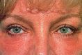Eyelid surgery (Blepharoplasty) - Photo before - Klinika Laser Esthetic
