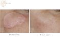 Laser Scar Treatment - Photo before - Dr n. med. Marcin Bieńkowski