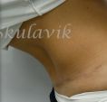 Abdominoplasty (Tummy Tucks) - Photo before - Dr. med. Jozefina Skulavik
