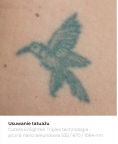 Tattoo removal - Photo before - Bieńkowscy Clinic®
