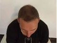 Haartransplantation - Vorher Foto - Prohaarklinik