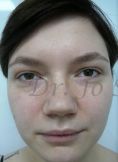 Septoplasty - Photo before - Dr. med. Jozefina Skulavik