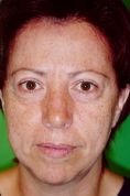 Fotorejuvenecimiento (IPL) - rejuvenecimiento de la piel - Foto Antes de - Dr. Aristides Arellano-Huacuja