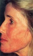 Mesotherapy (face, neck revitalization) - Photo before - Klinika Laser Esthetic