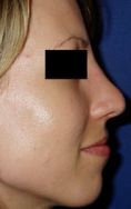 Rhinoplasty (Nose Job) - Photo before - Klinika Laser Esthetic