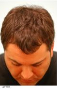 Hair Transplant - Photo before - Australian Institute of Hair Restoration