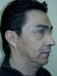 Fotorejuvenecimiento (IPL) - rejuvenecimiento de la piel - Foto Antes de - Dr. Aristides Arellano-Huacuja