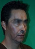 Fotorejuvenecimiento (IPL) - rejuvenecimiento de la piel - Foto Antes de - Dr. Aristides Arellano-Huacuja