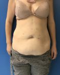 Abdominoplastie - Photo pré-opératoire et post-opératoire à 1 an de l