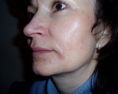 Laser skin tag removal - Photo before - Klinika Laser Esthetic
