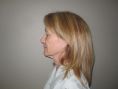 Facelift - Photo before - Boris Volshteyn MD