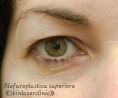 Blefaroplastica - Foto del prima - Skin Laser Clinic