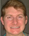 Ceramic facets - veneers - Photo before - Dr. Jonathan Penchas DMD